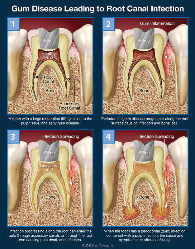 Gum Disease Leading To Infection - Root Canals Spring, TX