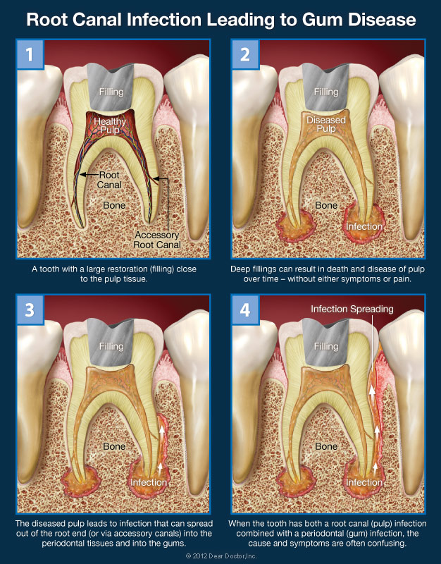 Dental Root Infection - Large Filling Leading to Gum Disease