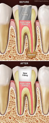 Root Canal Therapy - Root Canal Retreatment