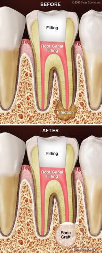 Root Canal Surgery - Bone Grafting Procedure