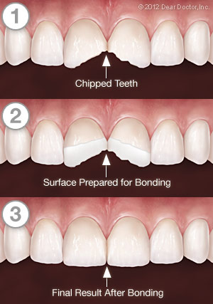 Cracked Teeth Repaired By Bonding